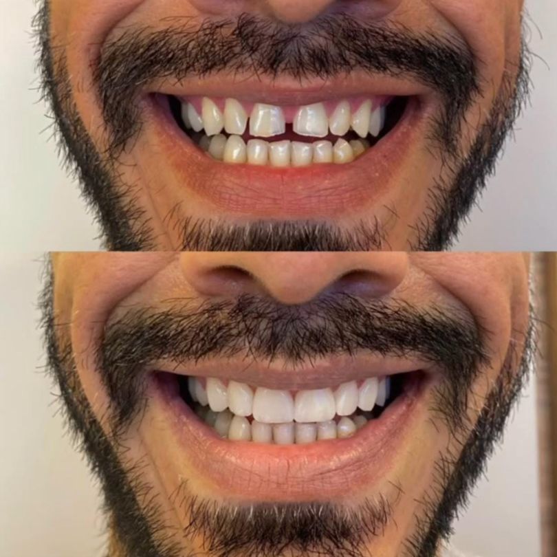 antes e depois implantes dentários em itajaí 02