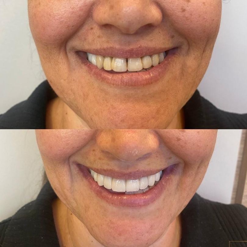 antes e depois implantes dentários em itajaí 01