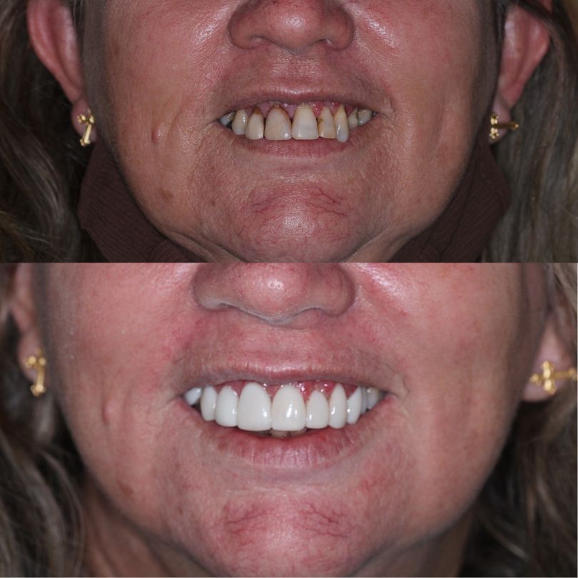 antes e depois implantes dentários em itajaí 03