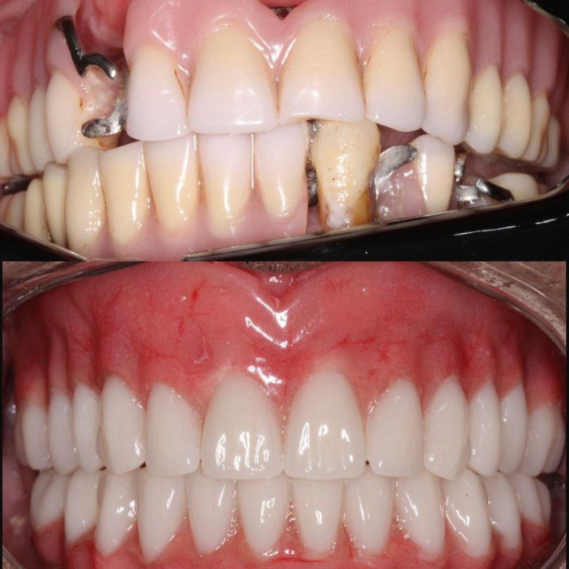 antes e depois implantes dentários em itajaí 04