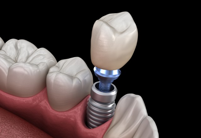 Implante Dentário Oral Brasil Itajaí